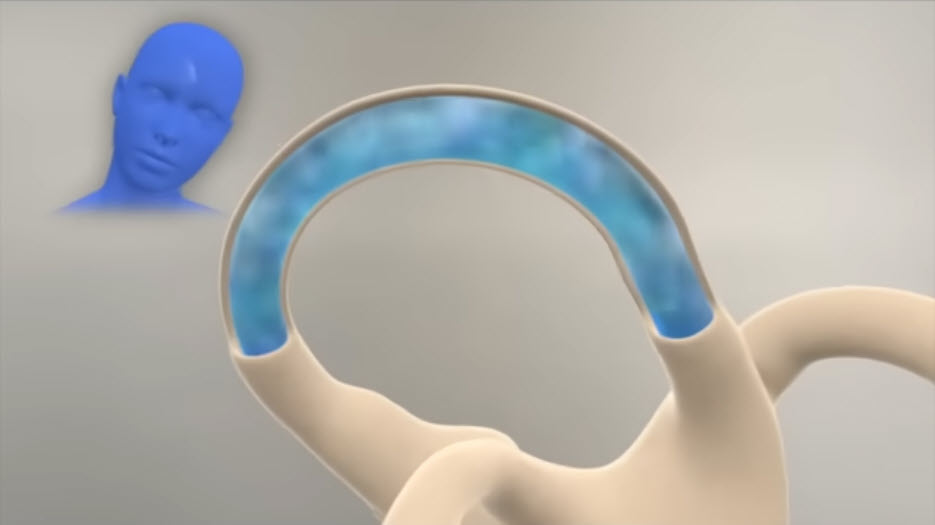 BPPV Vertigo